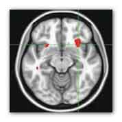 In people with major depression, low resting brain activity in the front part of the insula (red area where green lines converge on the right) predicted a higher likelihood of success with psychotherapy and a poor response to escitalopram. Source: Dr. Helen Mayberg, Emory University.