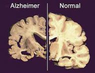 Morbo di Alzheimer: due esami del sangue ne rilevano marcatori precoci (20/05/2020)