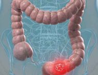 Colorectal cancer striking younger people (2019-06-19)
