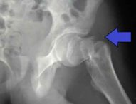 High doses of vitamins B6 and B12 tied to hip fractures in older women